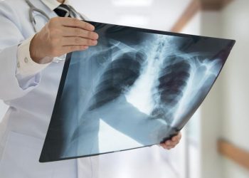 85 Persen Kanker Paru di Indonesia Terdeteksi pada Stadium Akhir