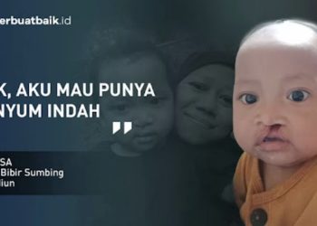Bantu Operasi Khalisa untuk Sembuh dari Bibir Sumbing melalui Donasi