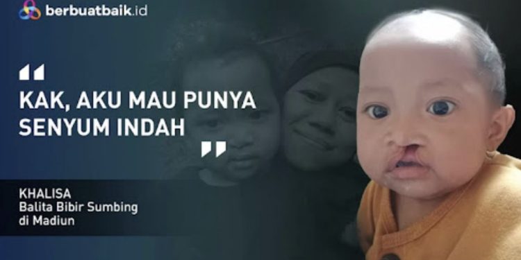 Bantu Operasi Khalisa untuk Sembuh dari Bibir Sumbing melalui Donasi