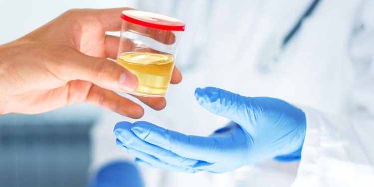 Ciri-ciri Gagal Ginjal yang Dapat Dilihat dari Air Kencing