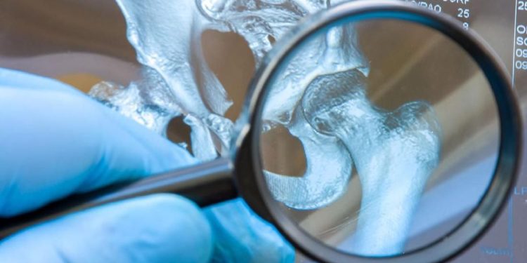 Asam Urat Penyebab Sakit Ginjal? Simak Penjelasannya di Sini