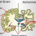 Kenali Ciri-Ciri Alzheimer Agar Tidak Salah Pahami