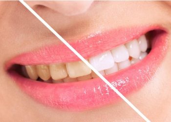 10 Fakta Mengejutkan yang Dapat Menyebabkan Gigi Kuning