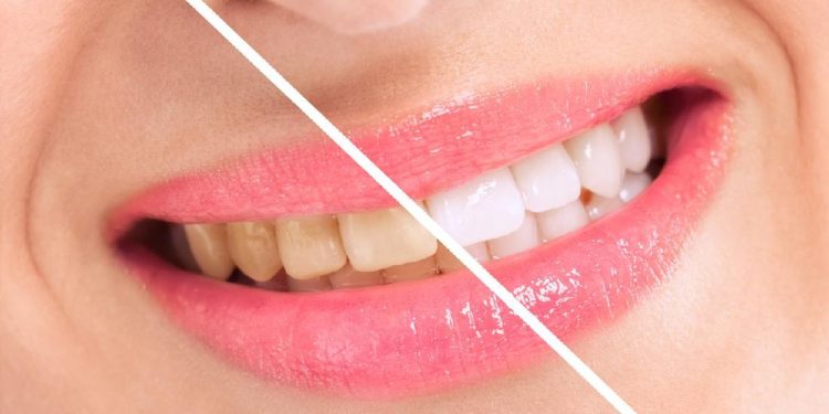 10 Fakta Mengejutkan yang Dapat Menyebabkan Gigi Kuning