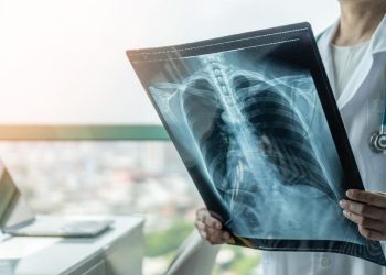 Gejala Kanker Paru Terkait Kondisi Kuku dan Tandanya