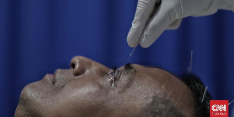 Manfaat Terapi Akupunktur untuk Kesehatan dan Penyembuhan