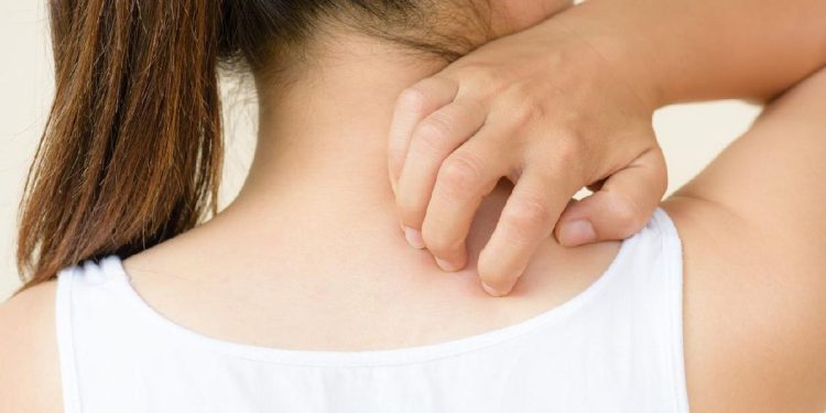 5 Gejala Penyakit Ginjal di Kulit yang Perlu Dikenali Sebelum Makin Parah